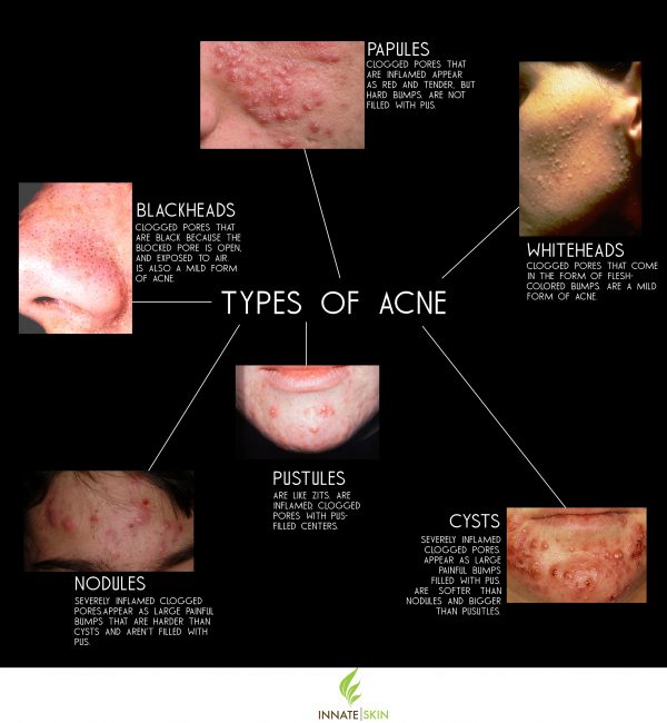 How To Recognize What Kind Of Acne You Have Innate Skin