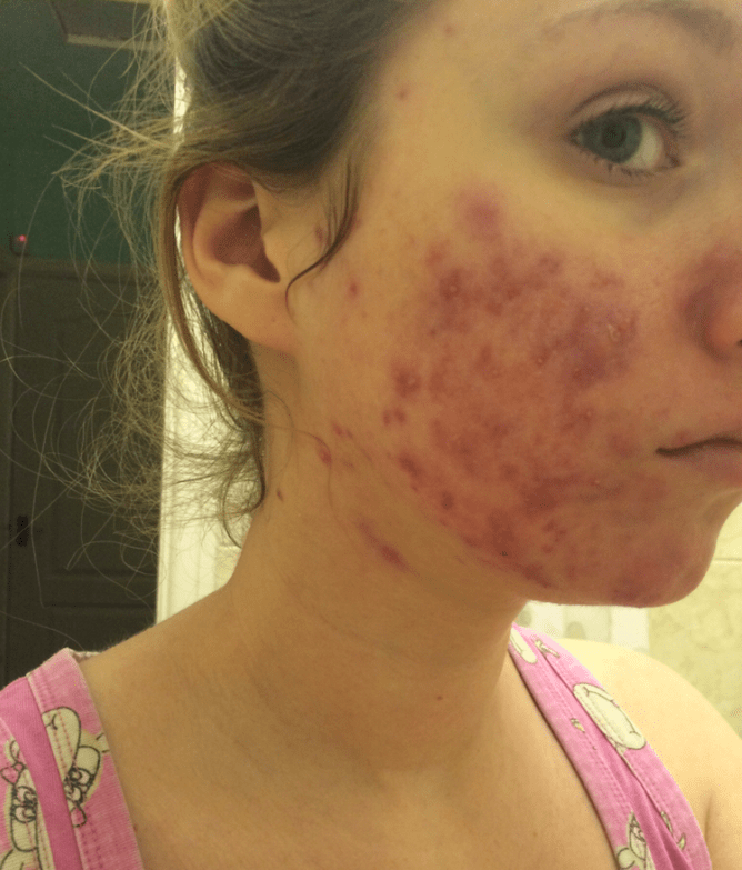 Natural Acne Alternatives to Isotretinoin (Accutane) Innate Skin