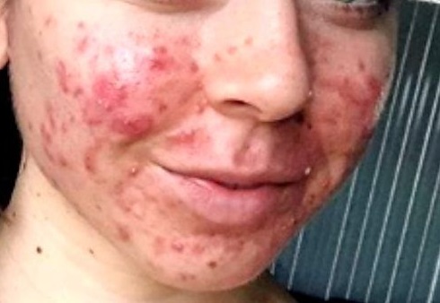 How Do I Get Rid Of Cystic Acne? - Innate Skin